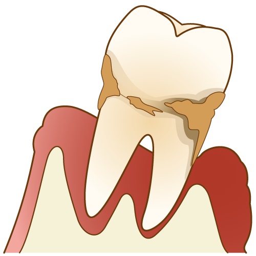 歯周病　嚙み合わせ　むし歯　歯がぐらぐら　歯ぎしり