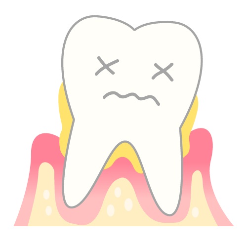 歯槽膿漏とは？歯肉炎、歯周炎との違いや症状、治療法を解説