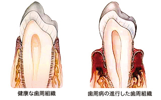 歯周病の原因から治療、予防まで徹底解説!再発防止のメンテナンス方法も紹介