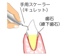 歯科クリーニングで痛みを感じる方必見!原因と対処法を解説