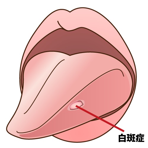 歯茎に白いできものができたら要注意！考えられる原因と対処法