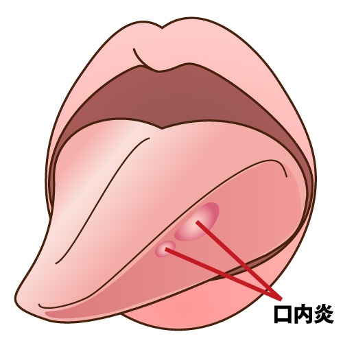 口内炎が痛い!治療方法はあるの?