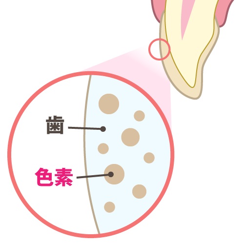 歯の変色の原因と治療法を徹底解説