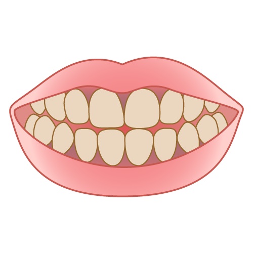 喫煙が歯に与える影響とは?口腔の健康に与える悪影響を解説
