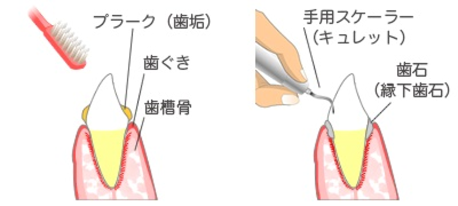 歯周病治療の流れ:検査からメンテナンスまでの全プロセスを解説