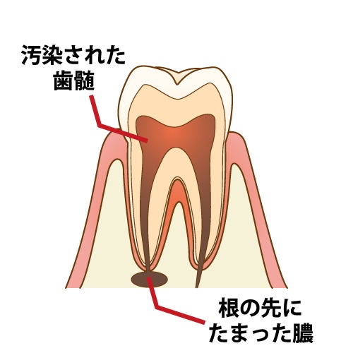 歯茎を押すと痛い原因と考えられる疾患