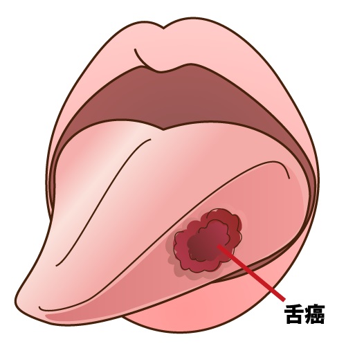 舌炎と舌癌の違いを解説：症状の見分け方と早期発見のポイント