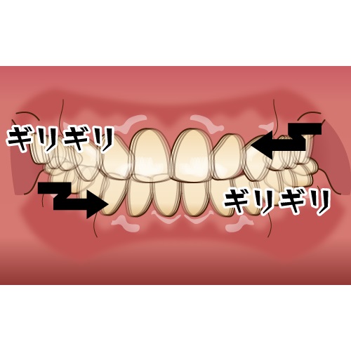 歯を食いしばる原因とその対策を解説