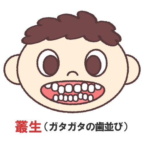 マウスピース矯正ができないケースとは
