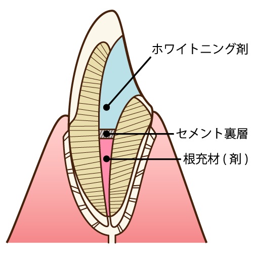 神経の無い歯に効果的!ウォーキングブリーチとは