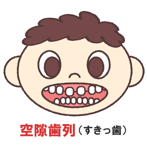 ダイレクトボンディング法とは？すきっ歯も改善できる方法について解説