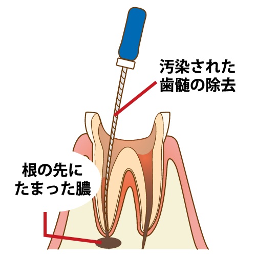 歯の治療を途中でやめるとどうなるか?リスクと影響を解説