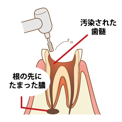 歯の神経を抜く治療の重要性とリスクを徹底解説