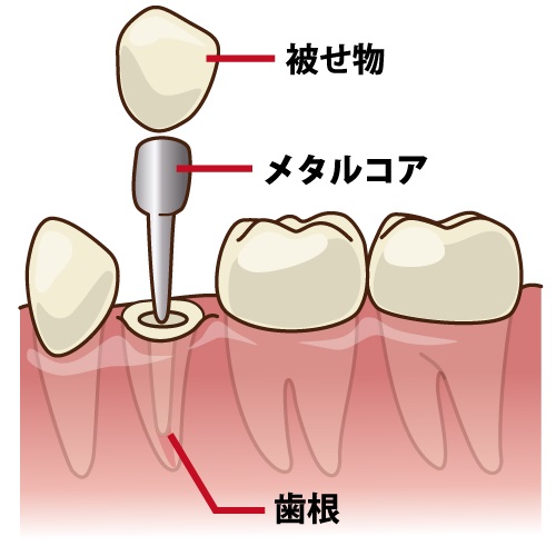 差し歯の根元が黒くなる原因とその対策