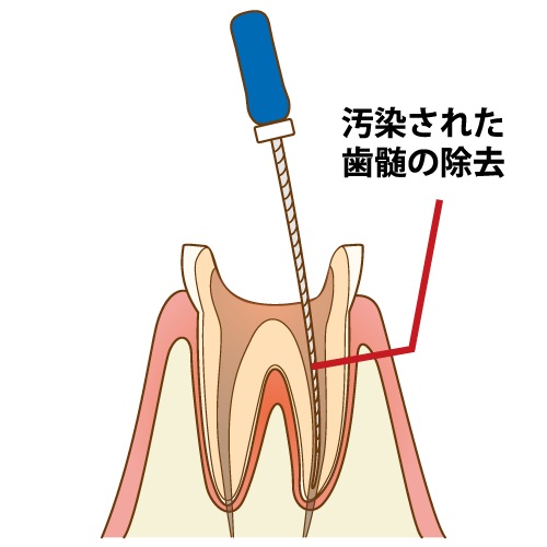 歯の被せ物治療の流れと期間について解説
