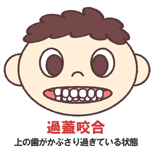 アンカースクリューを使った矯正のメリットとデメリットを紹介