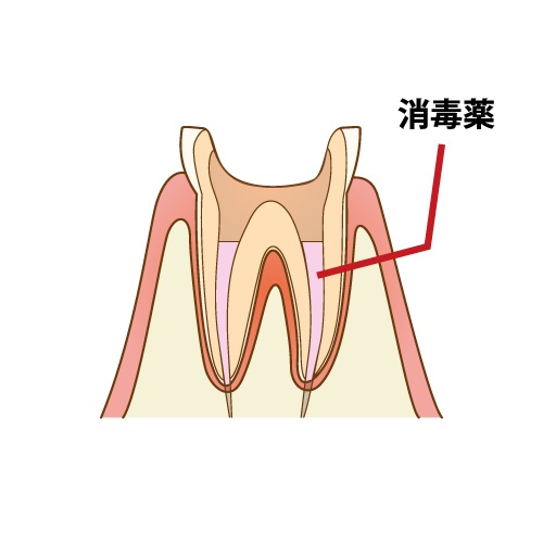 歯茎にできるニキビの正体とその治療法