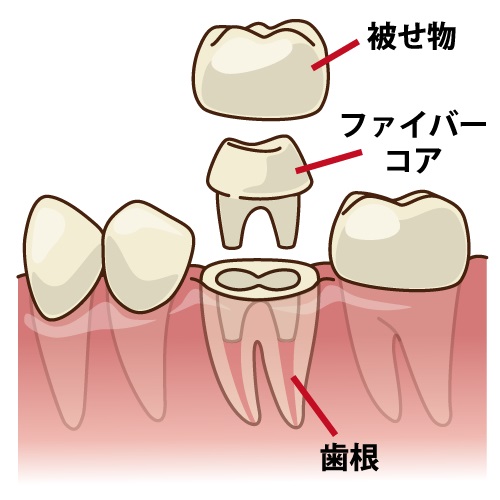 歯の根管治療の流れと重要性:感染した神経の除去から機能回復まで