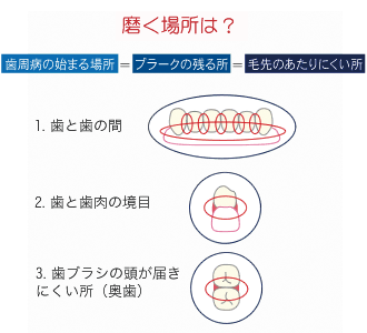 歯周病の原因から治療、予防まで徹底解説!再発防止のメンテナンス方法も紹介