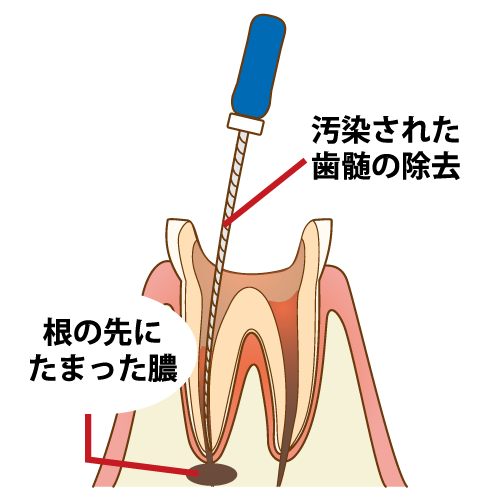 歯の神経を抜くとどうなる?メリット・デメリットと治療後の注意点