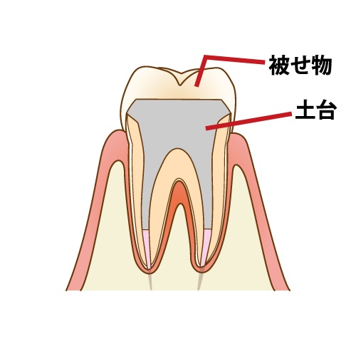 歯の神経を抜く治療の重要性とリスクを徹底解説