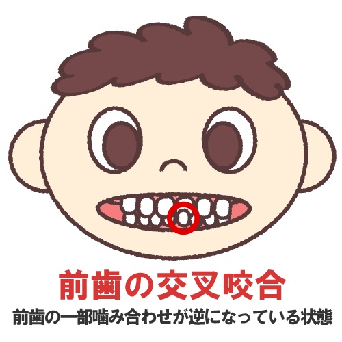 気になる歯並びの原因はクセかも?悪影響を与える習慣と改善法