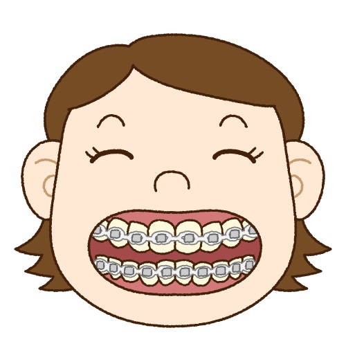 歯を抜かずに矯正する方法と抜歯が必要な場合