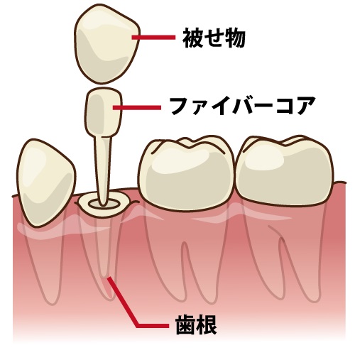 差し歯の根元が黒くなる原因とその対策