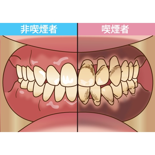 喫煙が歯周病を悪化させる理由とその対策方法