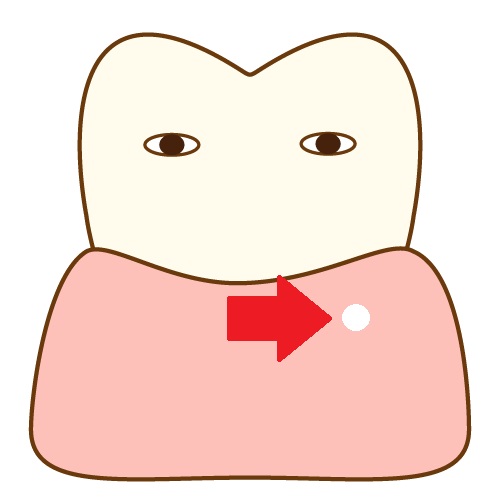 口内炎　歯ぐき　できもの