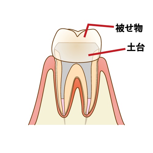 歯の被せ物治療の流れと期間について解説