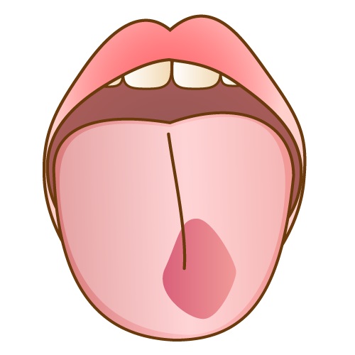 舌炎と舌癌の違いを解説：症状の見分け方と早期発見のポイント