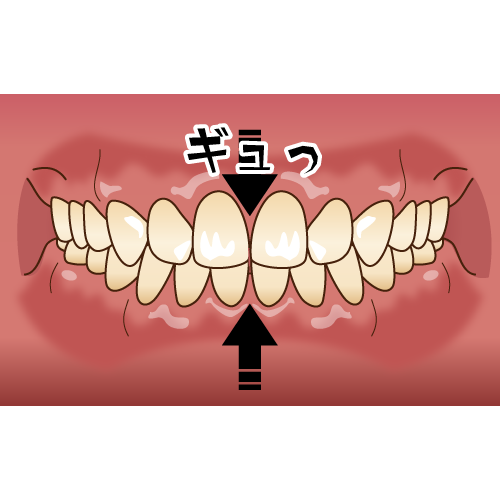歯医者で噛む力が強いと言われたら？歯や顎に起こるトラブルと対処方法